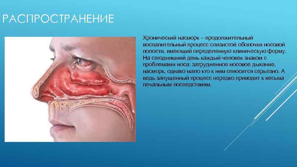 Атрофия слизистой носа: причины, симптомы, диагностика и лечение