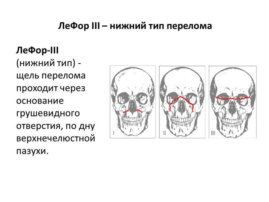 Перелом верхней челюсти: классификация по лефор, лечение