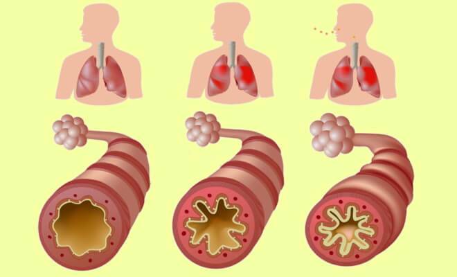 Бронхиальная астма – симптомы и лечение у взрослых