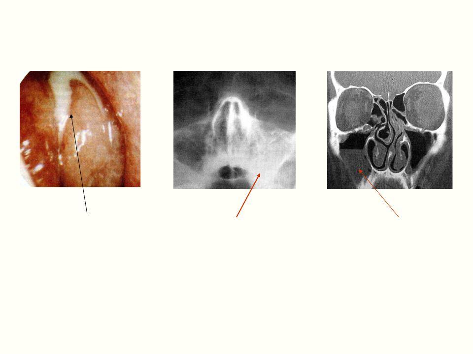 Верхнечелюстной синусит: особенности, симптомы, способы лечения