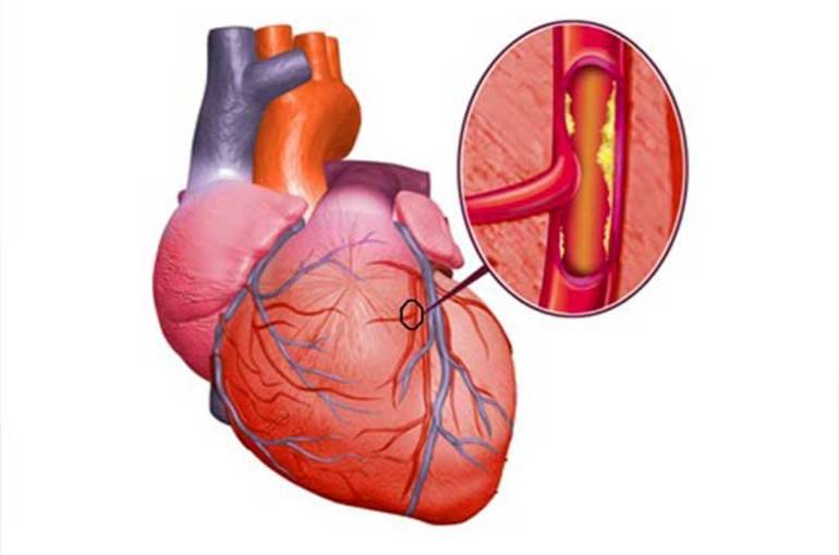 История болезни: ибс, нарушение ритма сердца - мерцательная аритмия, тахисистолическая форма, сердечная недостаточность ii а стадия