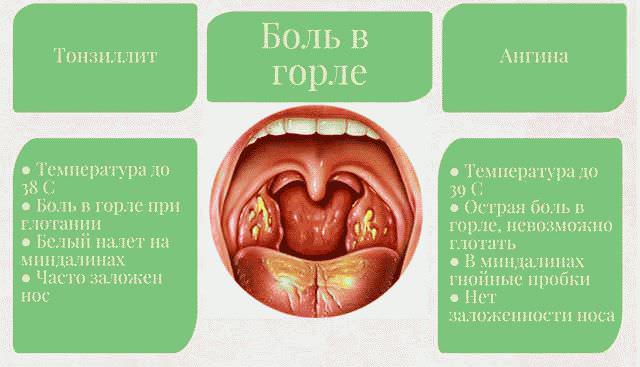 Почему горло болит? ларингит, тонзиллит, фарингит и еще 6 причин. как лечить боль в горле