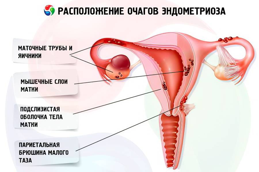 Лечение эндометриоза у женщин после 50 лет при климаксе