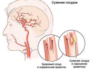 Сильная головная боль спазмами: причины, лечение, эффективные препараты - sammedic.ru