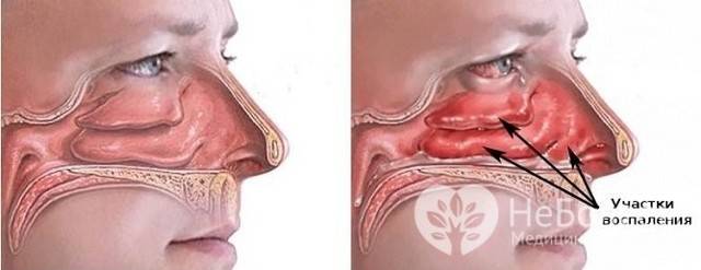 Гипертрофический ринит мкб-10: вазомоторная деформация носовой перегородки