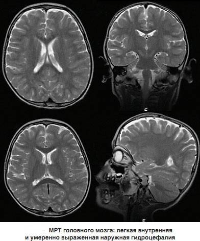 Заместительная гидроцефалия головного мозга у взрослых симптомы и лечение | целебные свойства растений
