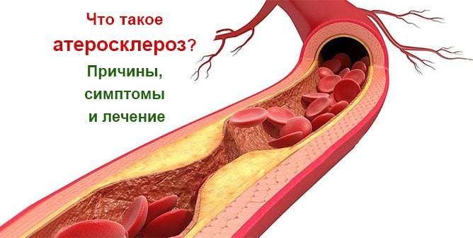 Атеросклероз сосудов сердца — что это за болезнь и как ее лечить?