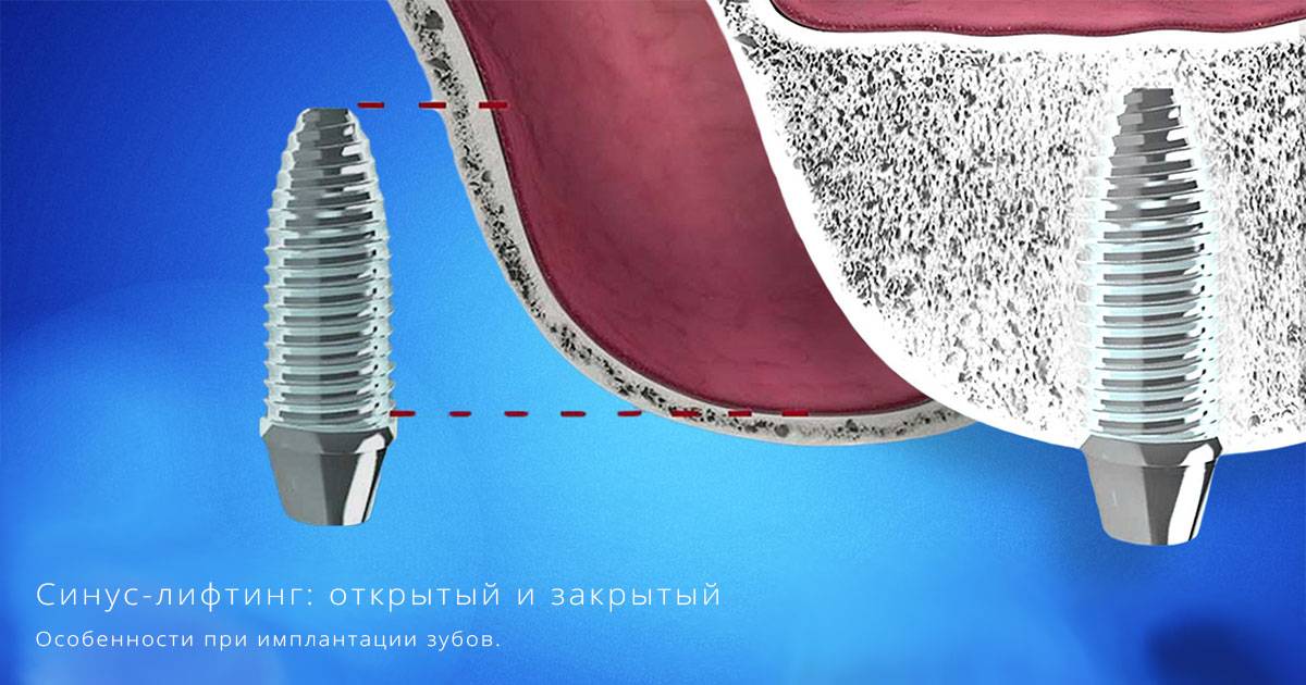 Синус-лифтинг челюсти при имплантации зубов. операция синус-лифтинг – методики, этапы проведения, заживление