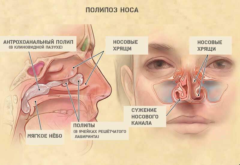 Заложенность носа без насморка: 15 причин и лечение у взрослых