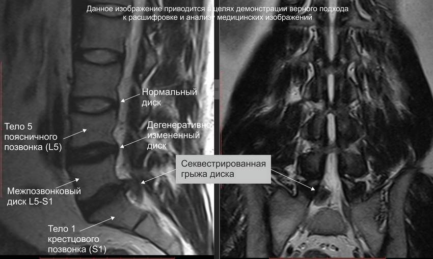 Операция по удалению секвестрированной грыжи позвоночника | спина доктор