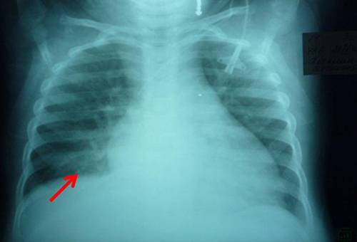 Мелкоочаговая пневмония у детей – симптомы и лечение очаговой - мед-часть
