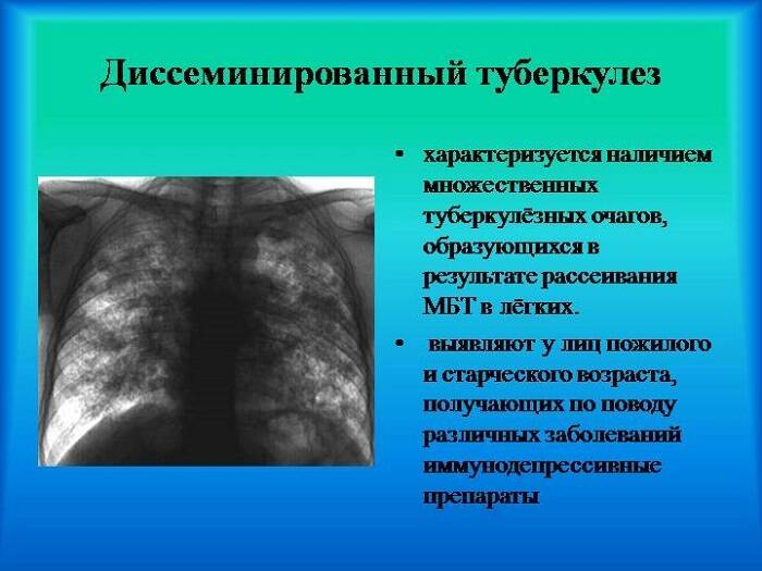 Инфильтративный туберкулез легких | компетентно о здоровье на ilive