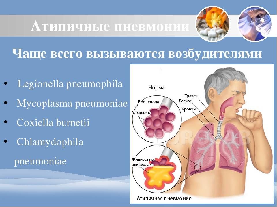 Пневмония заразна или нет у взрослых и детей для окружающих?
