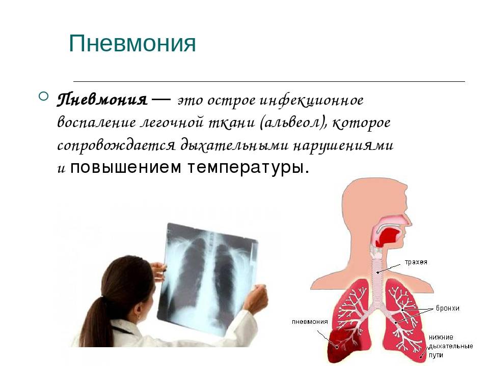 Пневмония - заразна или нет для окружающих людей, пути передачи pulmono.ru
пневмония - заразна или нет для окружающих людей, пути передачи