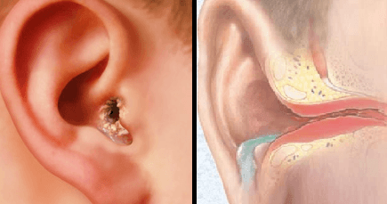 Острый наружный диффузный отит, как лечить диффузный отит наружного уха?