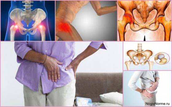 Как лечить артрит тазобедренного сустава