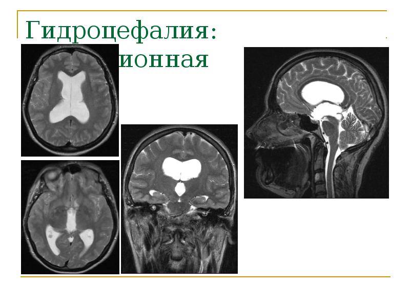 Наружная гидроцефалия головного мозга: что это такое, признаки и лечение