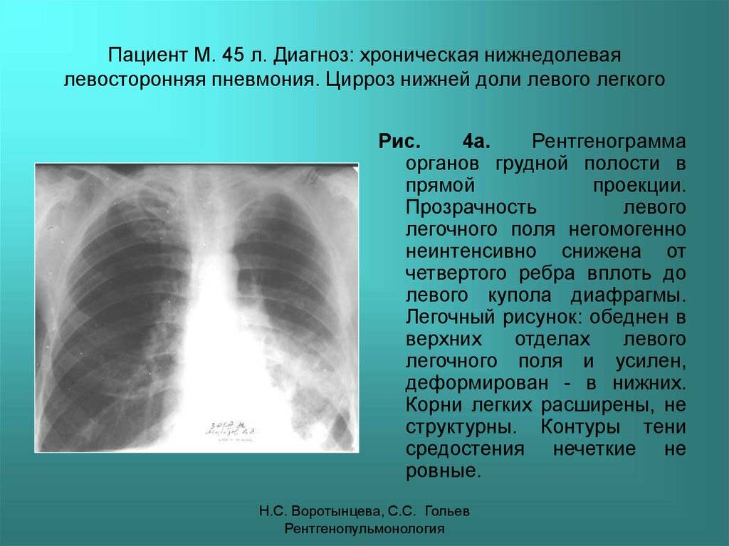 Характеристика левосторонней пневмонии и лечение заболевания