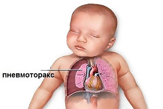 Пневмония у новорожденных (врожденная, внутриутробная): симптомы и лечение