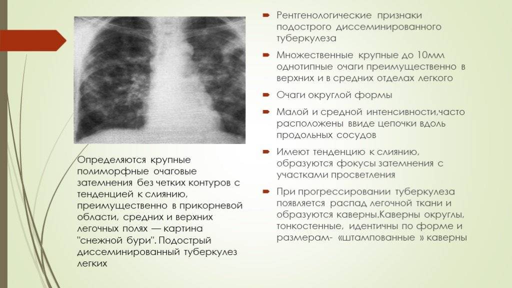 Клиническая классификация туберкулеза по международной классификации болезней 10 го пересмотра
