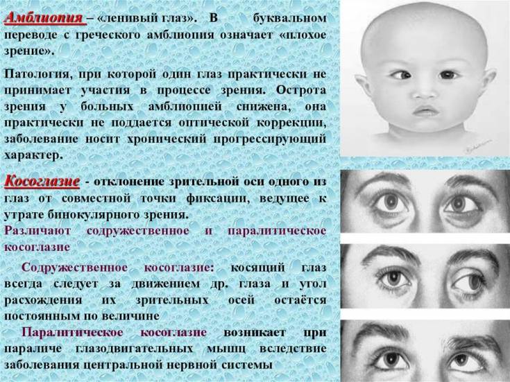 Лечится ли амблиопия у взрослых - лечение в домашних условиях, операция, что это такое, как лечить ленивый глаз, можно ли вылечить