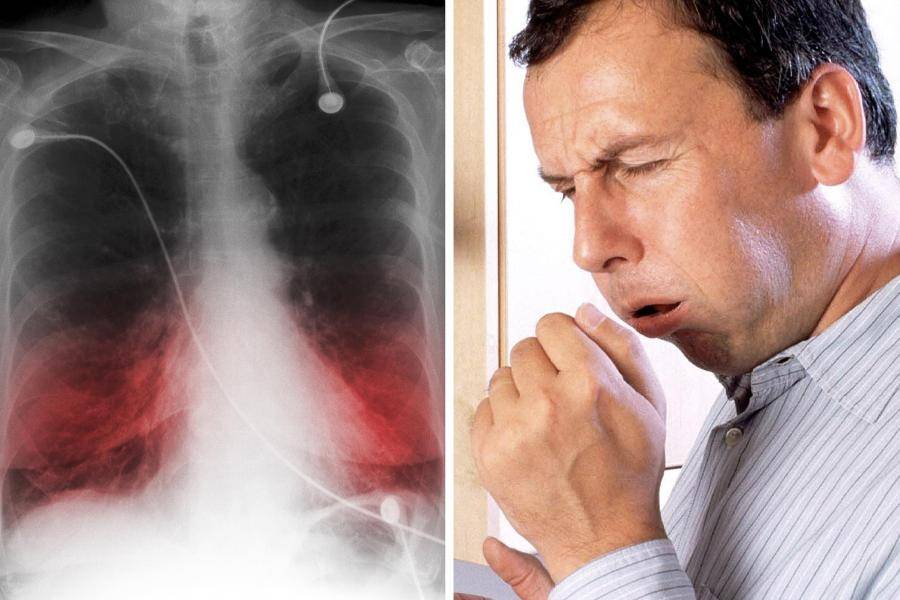 Пневмония - симптомы у взрослых с температурой, признаки воспаления легких у человека с кашлем, сбивается ли, какая держится