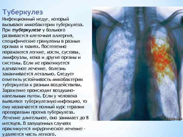 Отличия закрытой и открытой формы туберкулеза