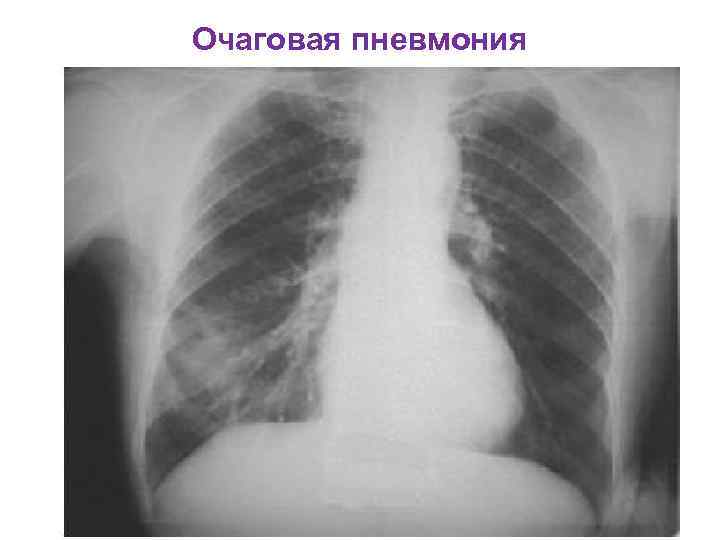 Правосторонняя пневмония: первые симптомы, лечение, профилактика