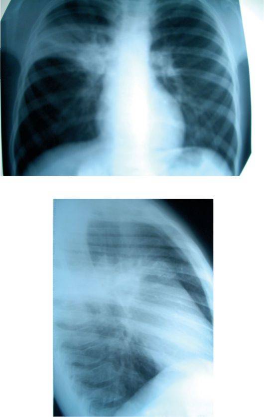 Очаговая пневмония: особенности заболевания
