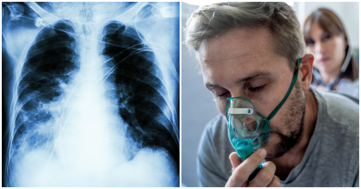 Пневмония у детей без температуры с кашлем: симптомы  и признаки, лечение