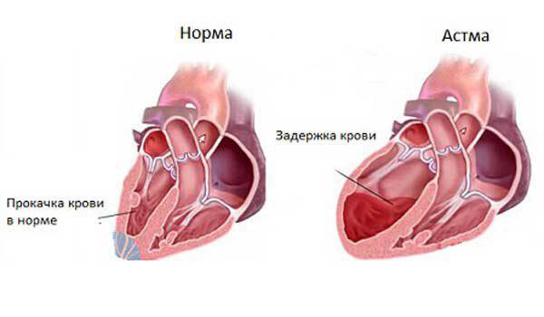 Эффективное лечение одышки при сердечной недостаточности