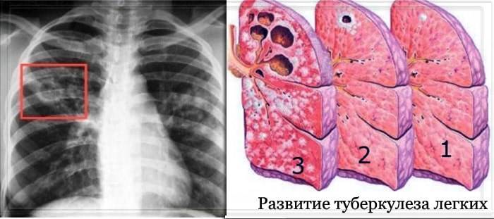 Туберкулез: симптомы, лечение, профилактика, признаки