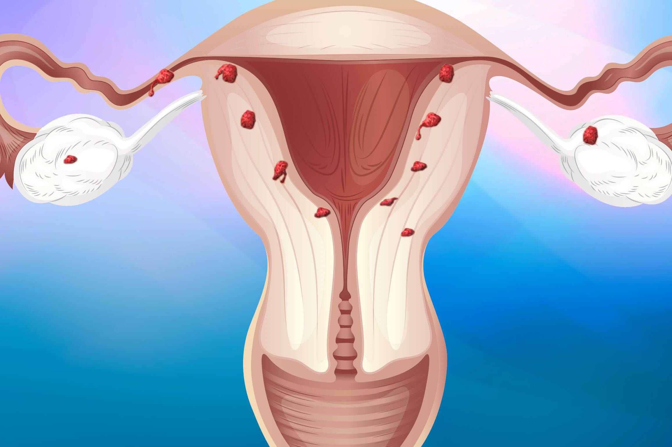 Симптомы и лечение эндометриоза матки при климаксе