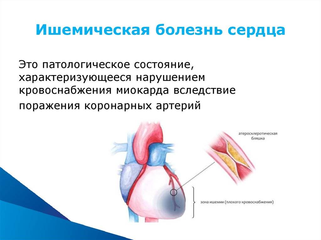 Ишемическая болезнь сердца (ибс)