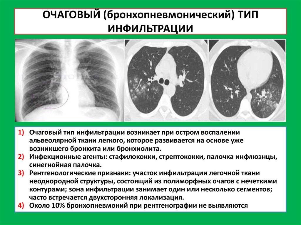 Очаговый туберкулез легких – симптомы, заразен или нет для окружающих