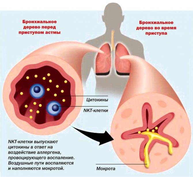 Что делать при приступе астмы – первая помощь в домашних условиях