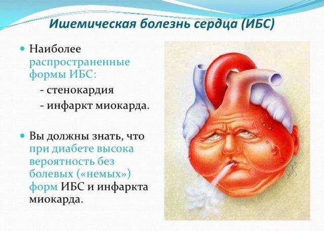Ишемическая болезнь сердца-диагностика, методы лечения ибс