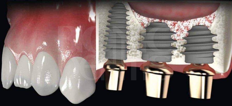 Синус-лифтинг при имплантации зубов: что это такое и как проводится?