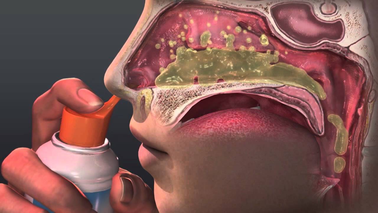 Причины и лечение заложенности носа без насморка и соплей