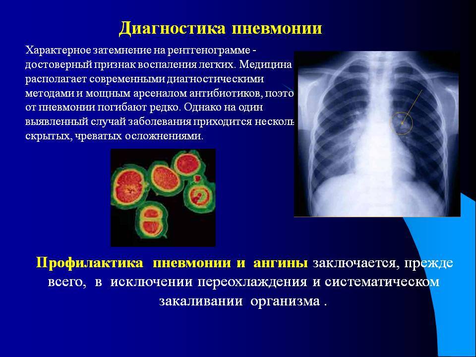 Скрытая пневмония: симптомы у взрослых и детей без температуры и кашля, атипичное воспаление лекгих, бессимптомная