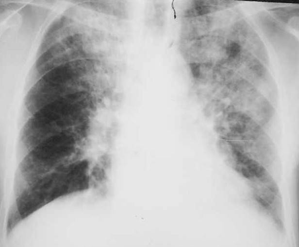Микоплазменная пневмония - особенности заболевания