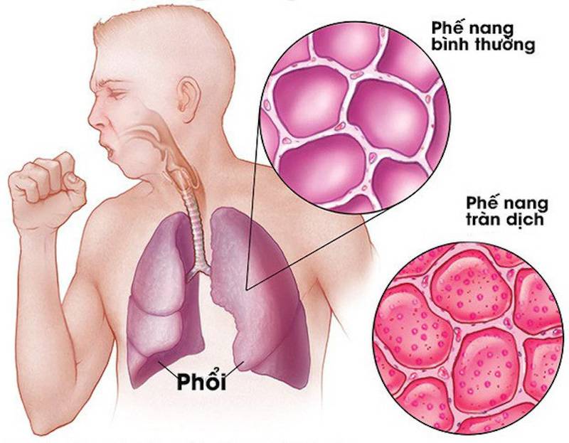 Эозинофильная пневмония: симптомы и лечение
