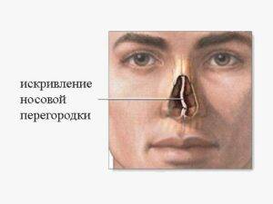 Искривление перегородки носа. последствия искривления носовой перегородки; лечение искривление перегородки код по мкб 10