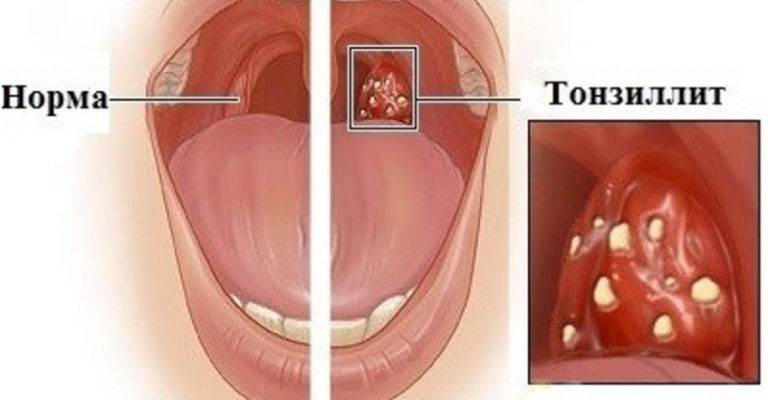 Симптомы  и лечение декомпенсированной формы тонзиллита