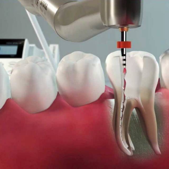 Депульпация зубов: как и зачем проводится. насколько болезненна