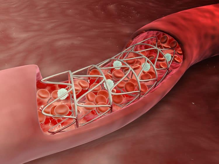 Противопоказания к стентированию коронарных артерий