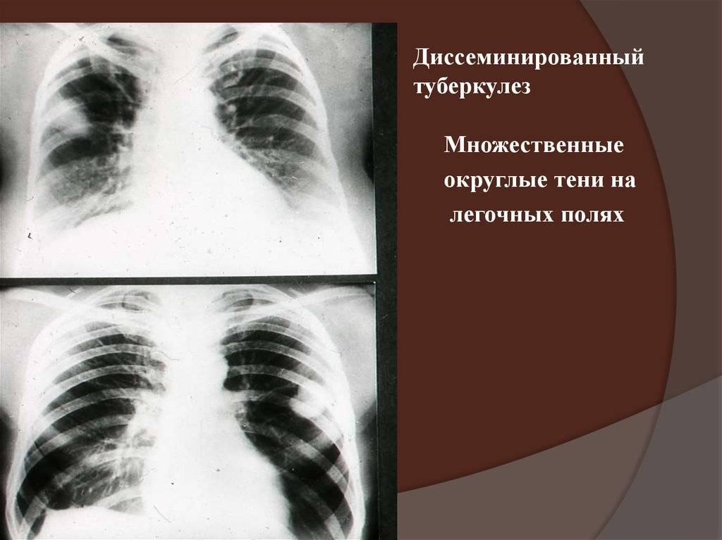 Клиническая классификация туберкулеза по международной классификации болезней 10 го пересмотра — стоптубик
