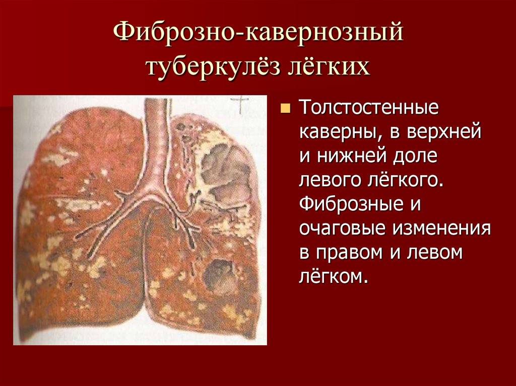 Формы туберкулеза легких, как передается и первые признаки на ранних стадиях