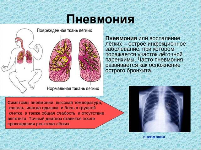 Пневмония без температуры, но с кашлем, симптомы пневмонии у взрослых без температуры, но с кашлем
