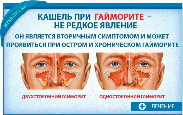 Верхнечелюстной синусит: что такое, лечение, виды (двусторонний, хронический, одонтогенный, катаральный, гнойный), болезнь у ребенка